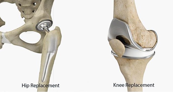 Joint Replacement Surgery