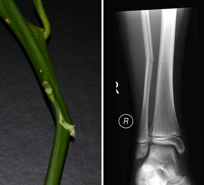 Greenstick Fracture