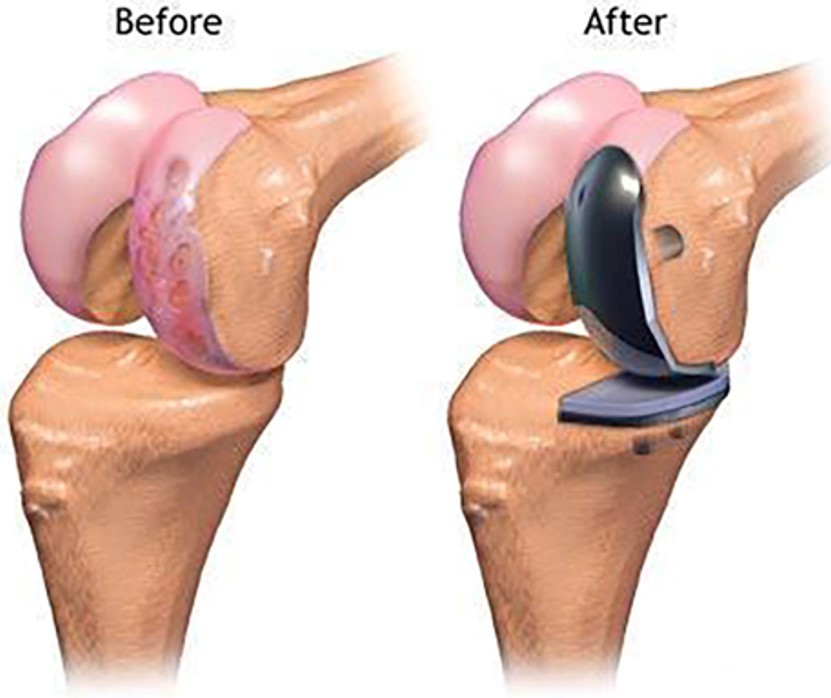 Partial Joint Replacement